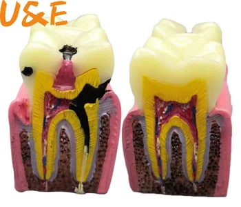6 Kez Diş Modeli Molar Patolojik Anatomik Karşılaştırma Modeli Çalışmasını Kolaylaştırmak için Diş Yapısı Ve Lezyon Süreci